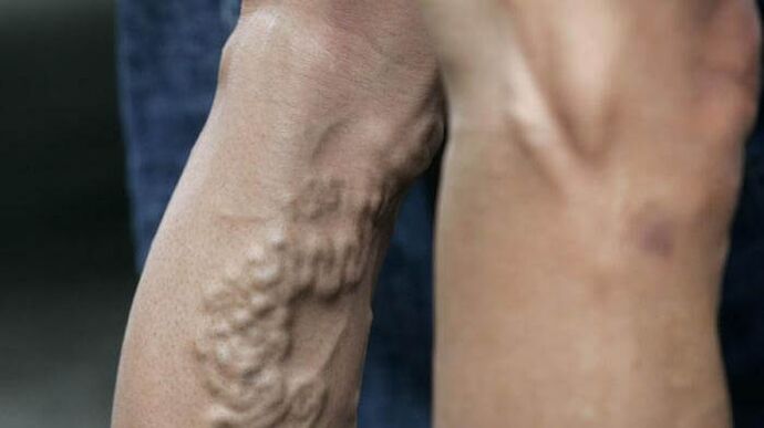 veins with advanced varicose veins