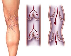 Normal valve function in a healthy vein and valve pathology in varicose veins