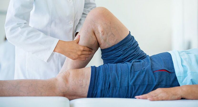 Advanced stage of varicose veins