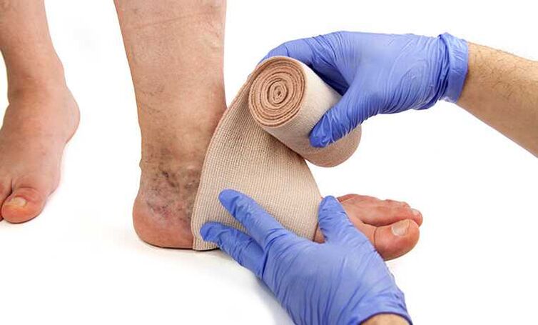 The treatment of varicose veins in the legs is complemented by the use of compression stockings