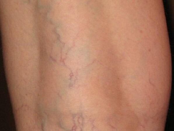 The type of vein with varicose