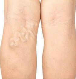 The symptoms of varicose veins