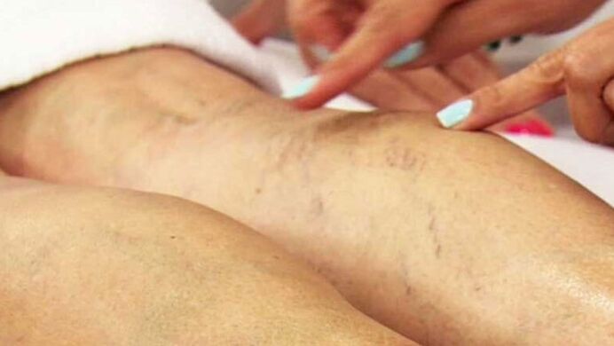 Varicose veins of lower extremities
