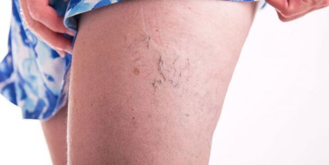 Varicose veins