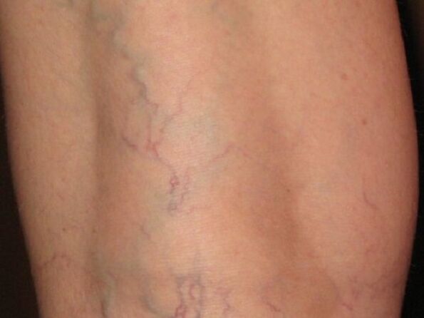The phases of varicose veins