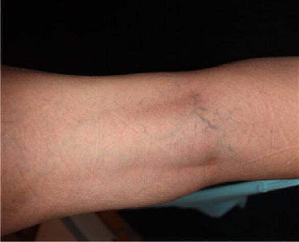 The symptoms of varicose veins