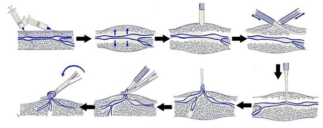 Varadi operation
