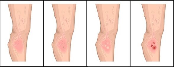 Varicose vein rate
