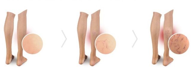 varicose veins
