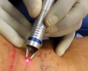 How the laser of varicose veins are performed