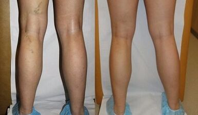 Laser treatment of varicose vein pictures before and after