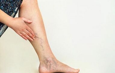 How to treat varicose veins of lower extremities