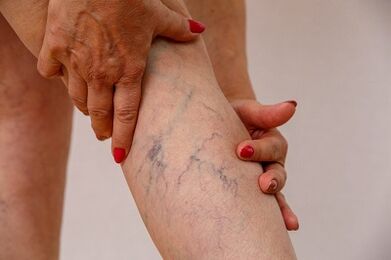 varicose veins of lower extremities