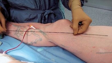 How the operation for varicose veins is performed