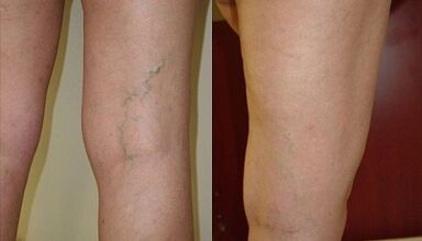 microphlebectomy for varicose veins