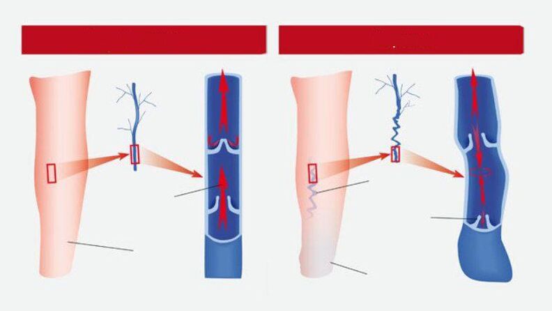 How the varicose veins look like