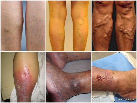 The degree of damage to the varicose veins